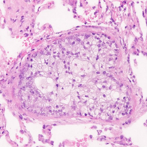 Tumorembolus (Lunge)